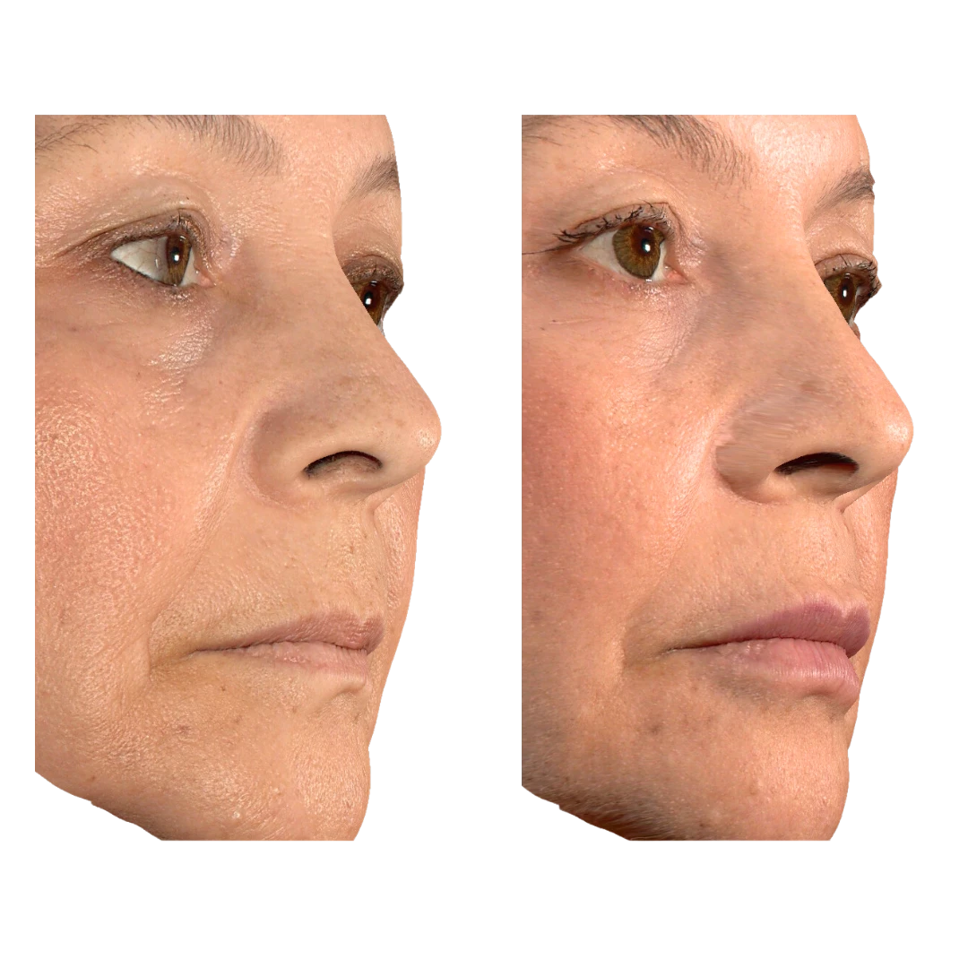 ARMONIZACIÓN DE LABIOS (ÁCIDO HIALURÓNICO)