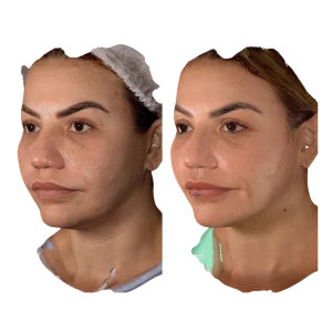 ULTHERAPY MEJILLAS Y PAPADA