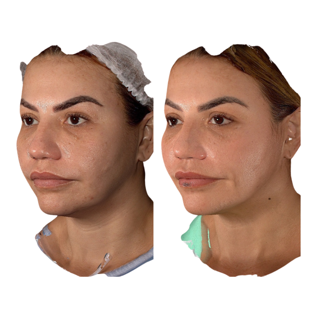 ULTHERAPY MEJILLAS Y PAPADA