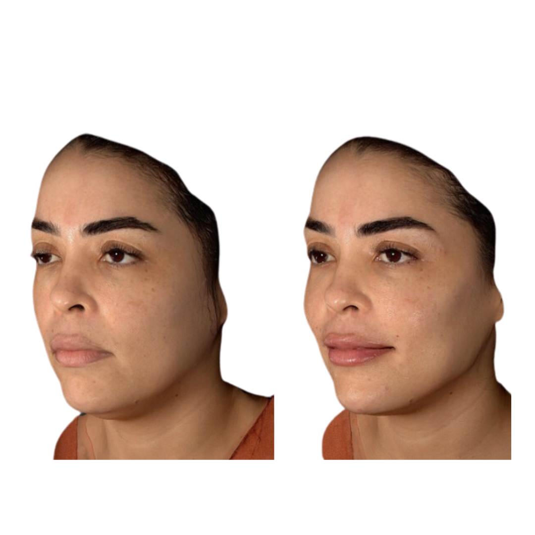 ARMONIZACIÓN DE LABIOS (ÁCIDO HIALURÓNICO)