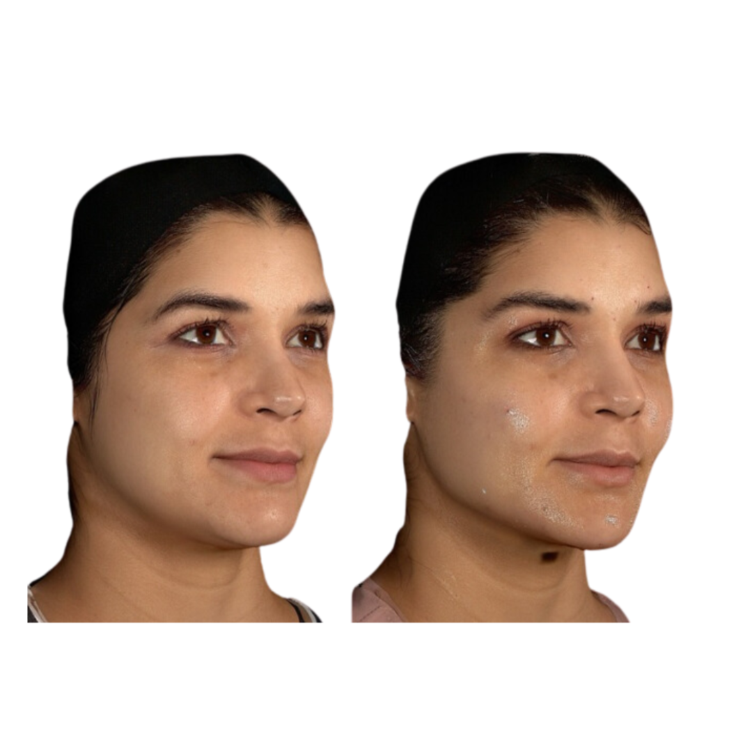 CONTORNO FACIAL (RADIESSE)