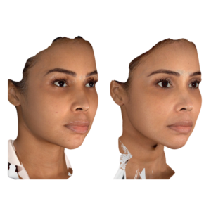 CONTORNO FACIAL (ULTHERAPY)
